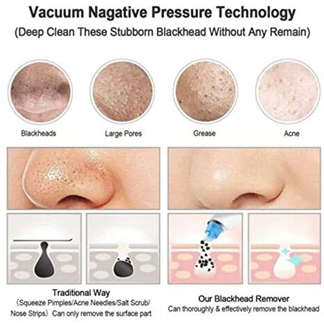 Blackhead Remover